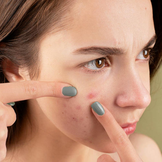 How to treat acne holistically