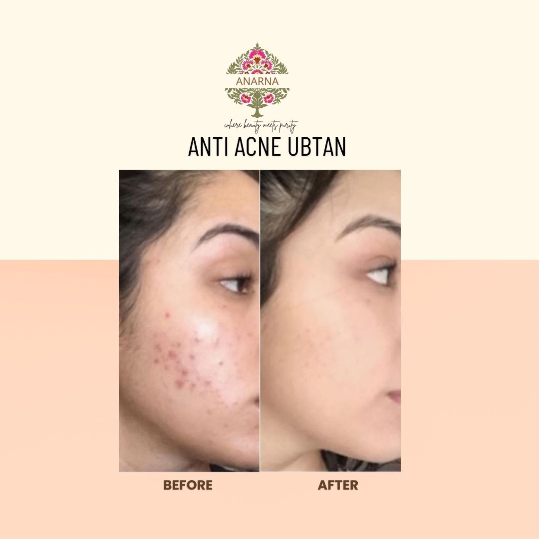 Anti Acne Ubtan | All Natural | Antiseptic | Neem Enriched